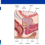 prostatectomy side effects