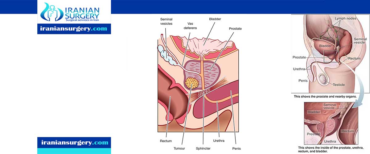 prostatectomy side effects