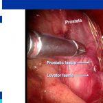 radical prostatectomy steps