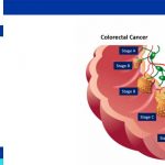 rectal cancer prognosis