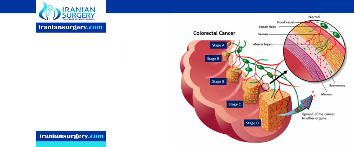 Survival Rates For Colorectal Cancer Iranian Surgery