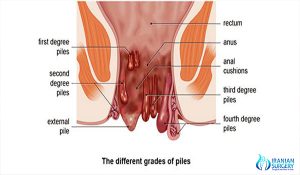 rectal cancer surgery in iran