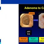 rectal cancer symptoms