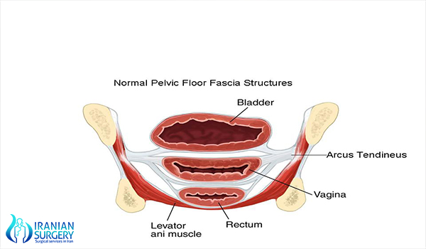 Rectocele Repair Surgery Iran Cost After Rectocele Surgery