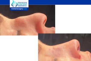 best revision rhinoplasty iran
