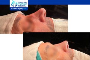 revision rhinoplasty in iran before after