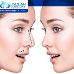 اسعار عملیات تجميل الانف في ايران