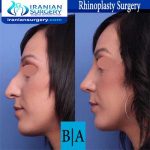 dr shahoon rhinoplasty surgery2
