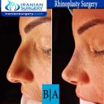 dr shahoon rhinoplasty surgery3