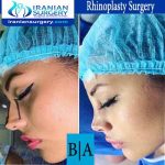 dr shahoon rhinoplasty surgery4