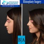 dr shahoon rhinoplasty surgery5