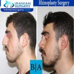 dr shahoon rhinoplasty surgery6