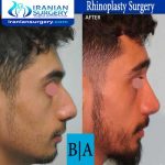 dr shahoon rhinoplasty surgery8