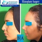 dr boromand rhinoplasty3