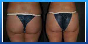 Pain after liposuction flanks