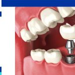 dental implant procedure