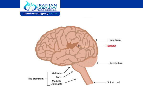 اعراض سرطان الدماغ