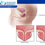 أعراض سرطان البروستاتا المتقدم