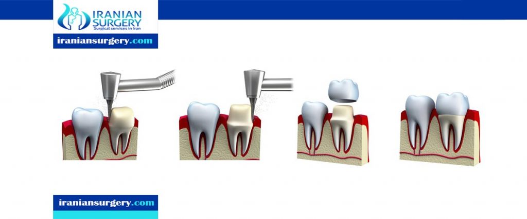 dental crown procedure