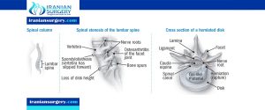 spinal stenosis treatment options