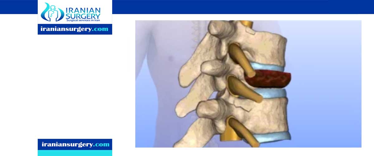spinal tumor treatment