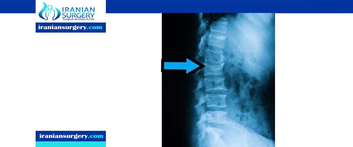 spine compression fractures treatment