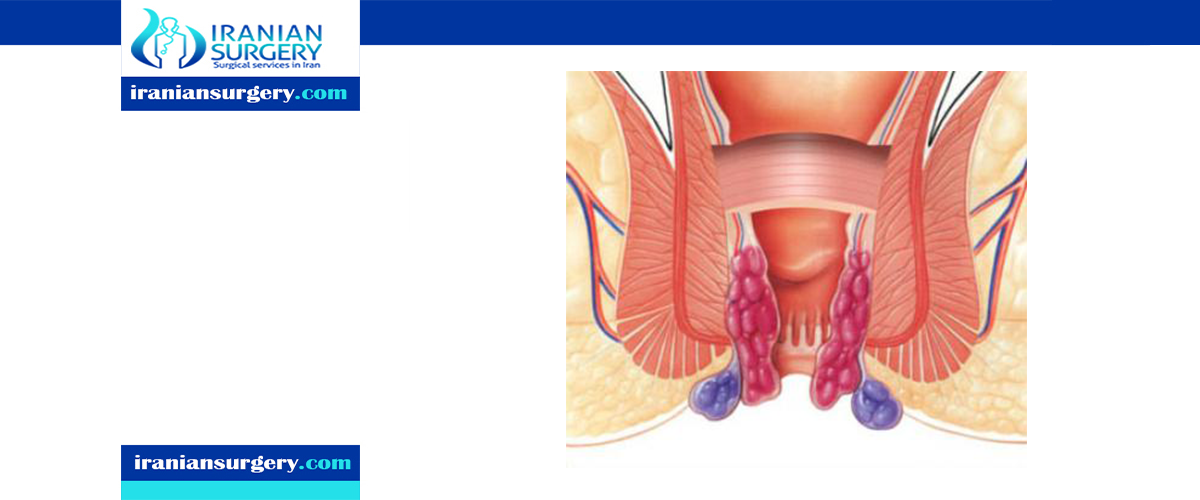 stapled haemorrhoidectomy procedure