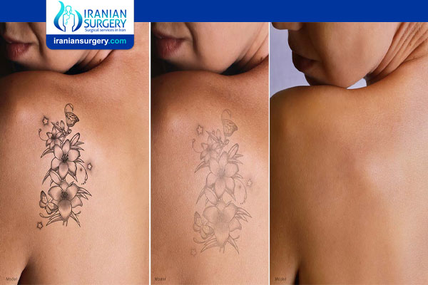 Tattoo removal | Iranian Surgery