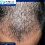 اضرار زراعة الشعر للرجال