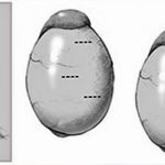 testicular biopassy in iran