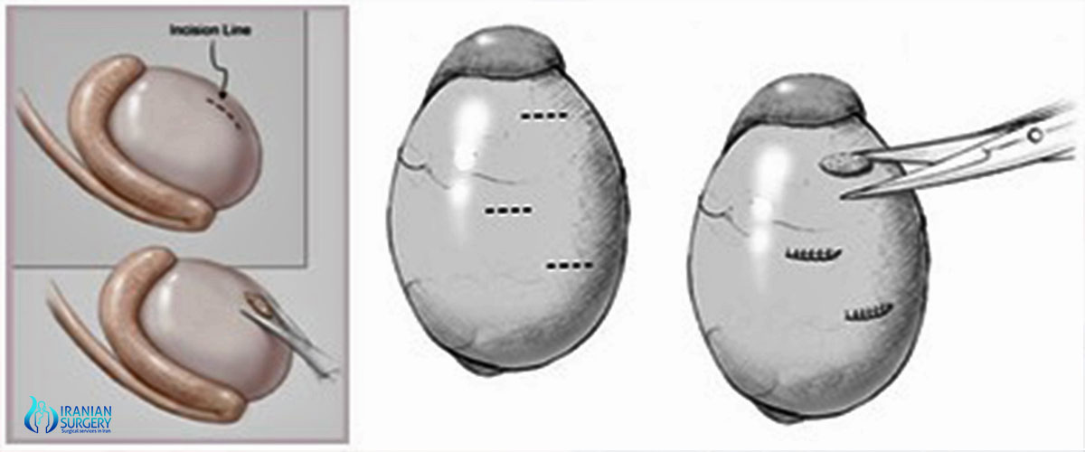 testicular biopassy in iran