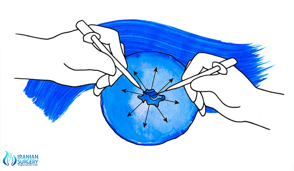 testicular biopassy in iran