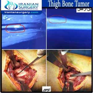 thigh-bone-tumor abolghasemzadeh