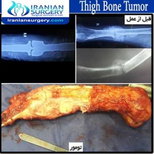 thigh-bone-tumor 4 abolghasemzadeh