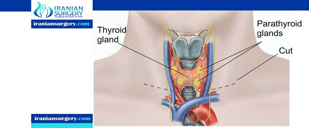 Thyroidectomy complications