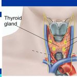 Thyroidectomy complications