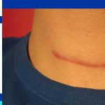 Thyroidectomy scar