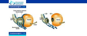 transurethral resection of the prostate