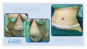 tummy tuck before after4 1