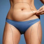 tummy tuck with liposuction in iran