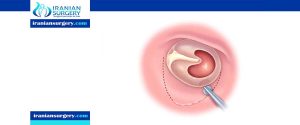 tympanoplasty surgery in Iran