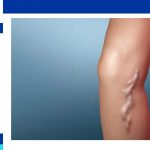 varicose vein laser surgery in Iran