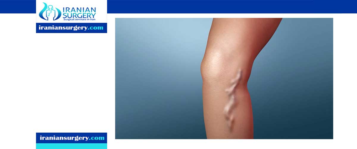 varicose vein laser surgery in Iran