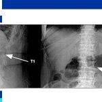 vertebral compression fracture treatment in elderly