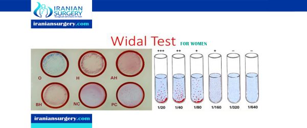 widal-test-iranian-surgery