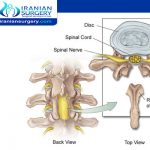 what is Laminectomy Surgery?