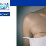 Mastectomy