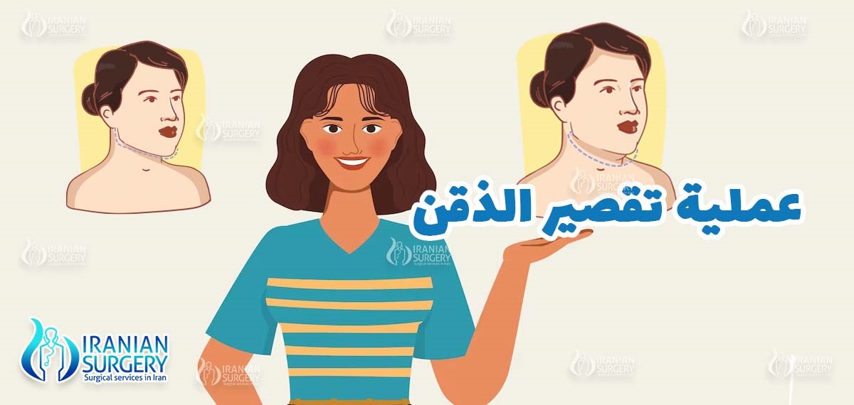 عملية تقصير الذقن