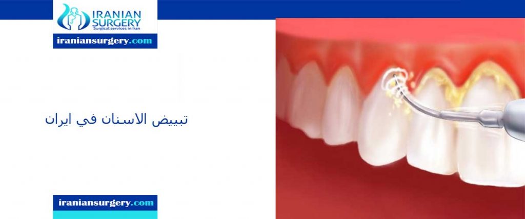 تبييض الاسنان في ایران