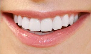 عملیة تجمیل الاسنان- اللومنیرز